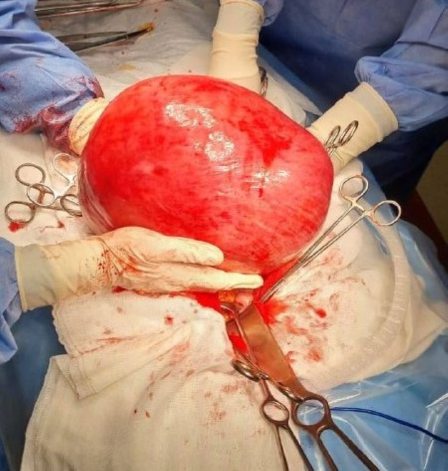 Врачи из Владивостока удалили гигантскую миому весом в 15 килограммов