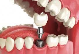 Фото: freepik.com | Почему имплантация зубов – самая популярная процедура в стоматологии сегодня?