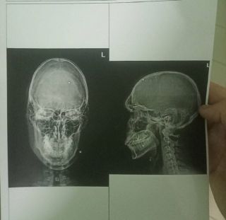 Молодой человек в Артёме получил две пули в голову от своих недругов