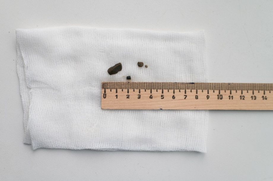 Врачи в шоке: из трахеи четырёхлетней девочки извлекли аж четыре камня