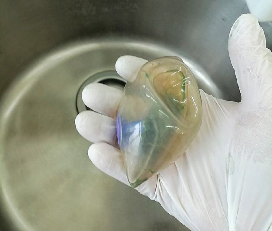 Врачи из Находки спасли пациентку с силиконовым шаром в желудке